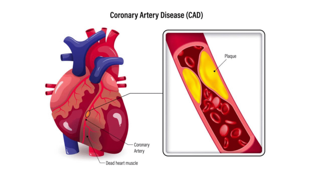 Calcified Arteries
